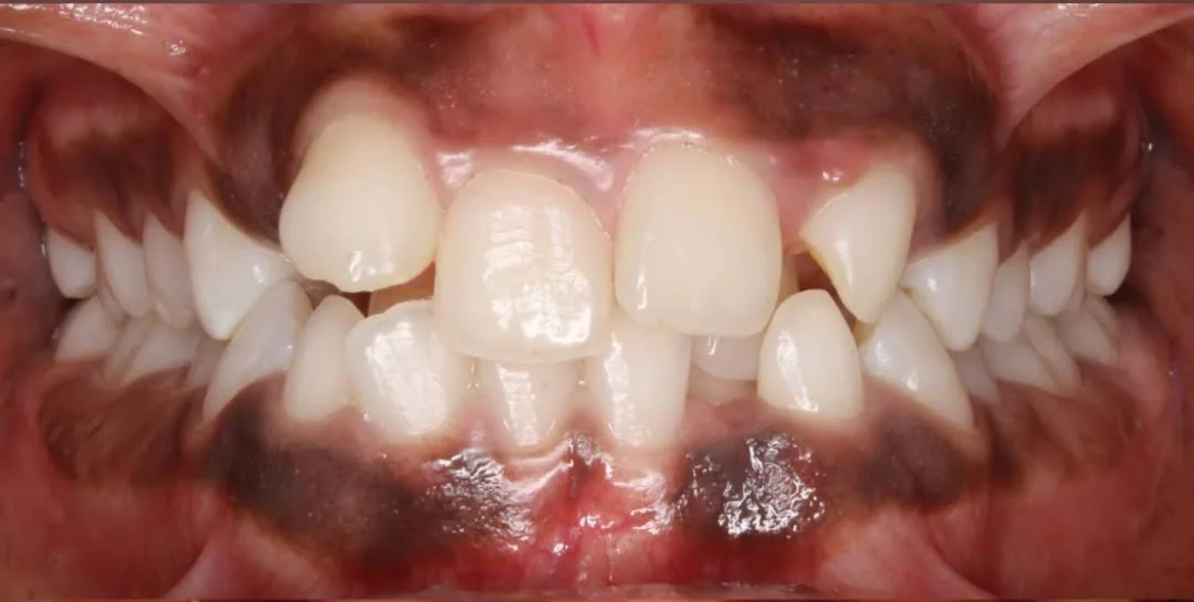 After treatment